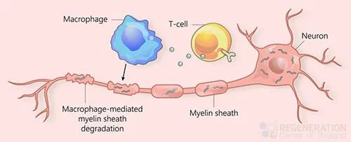 肌萎縮側(cè)索硬化癥 (ALS)、運動神經(jīng)元疾病 (MND)