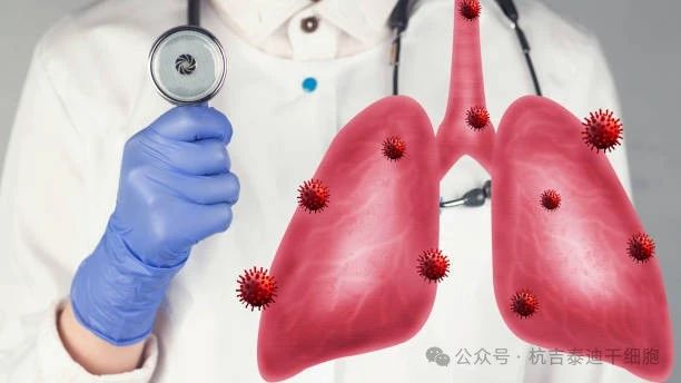 干細(xì)胞療法如何減緩肺部疾病的癥狀？