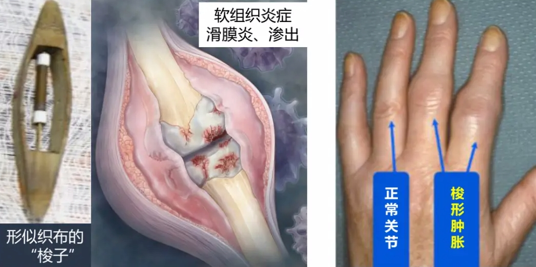類風(fēng)濕關(guān)節(jié)炎